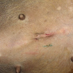 Destiny, 8 days after surgery. Incision edges moved, some pink tissue visible.